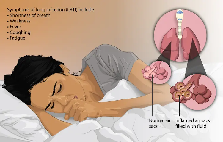 Lower Respiratory Tract Infection representation