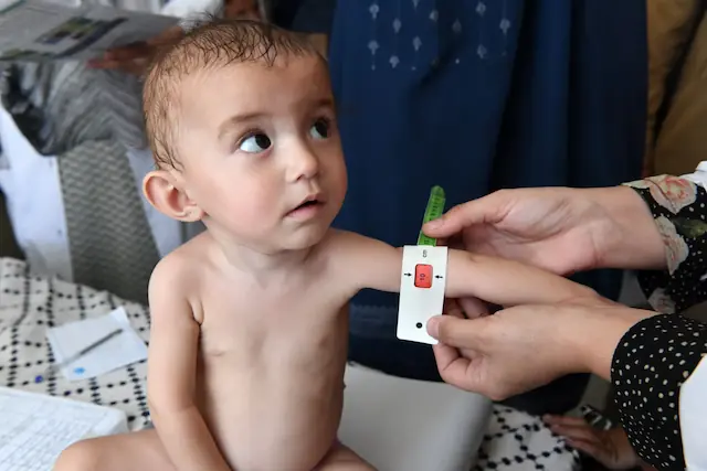 Malnutrition representation