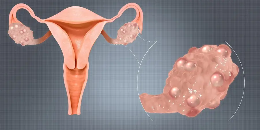 Polycystic Ovarian Disease (PCOD) representation