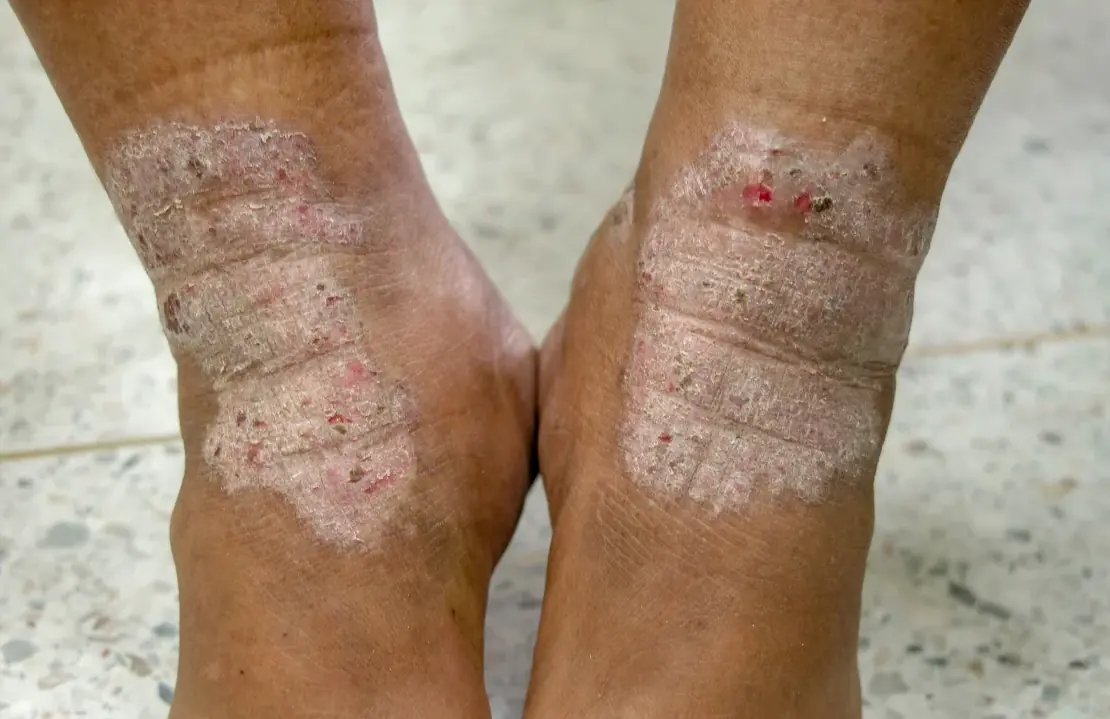 Eczema / Atopic Dermatitis representation