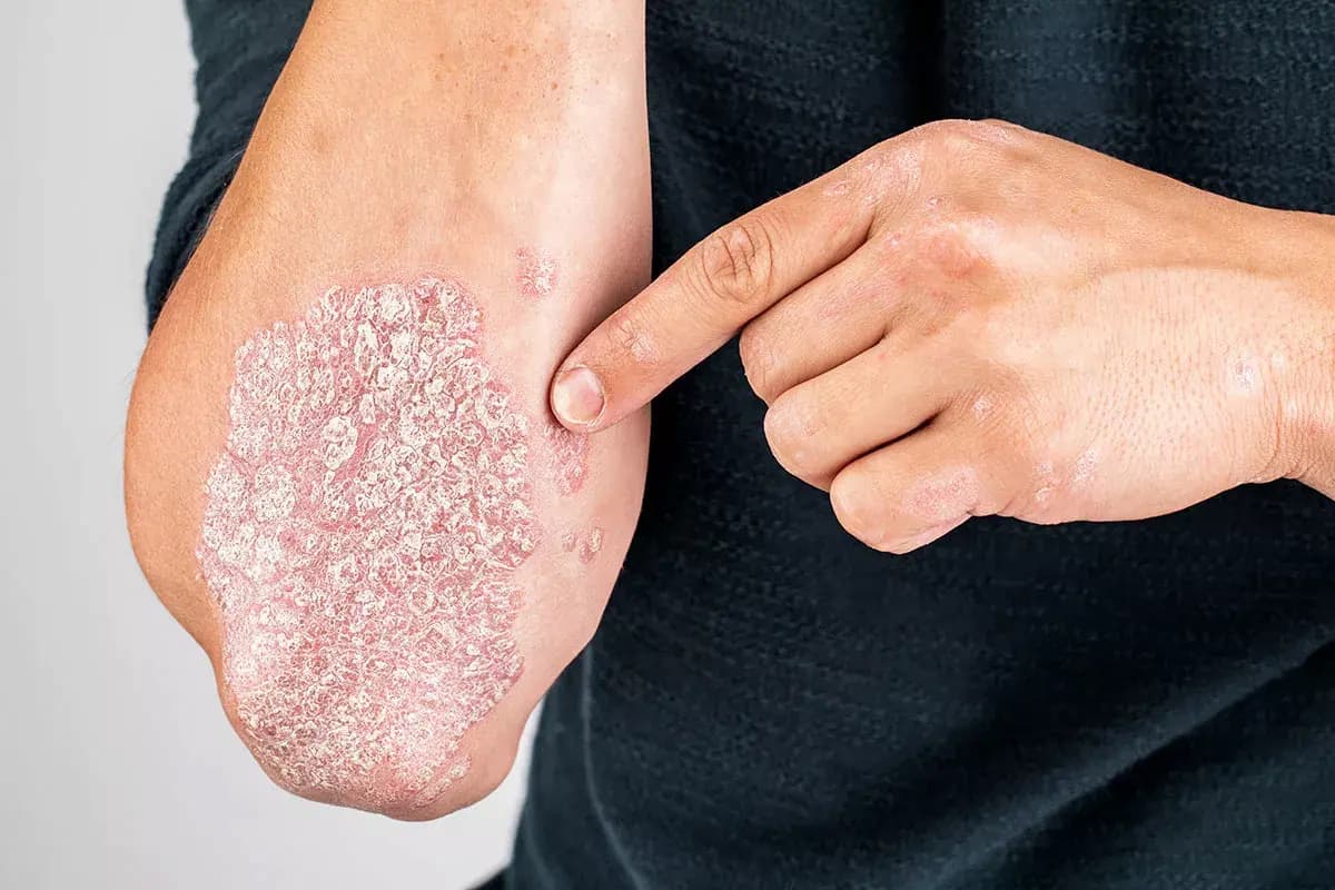 Psoriasis representation