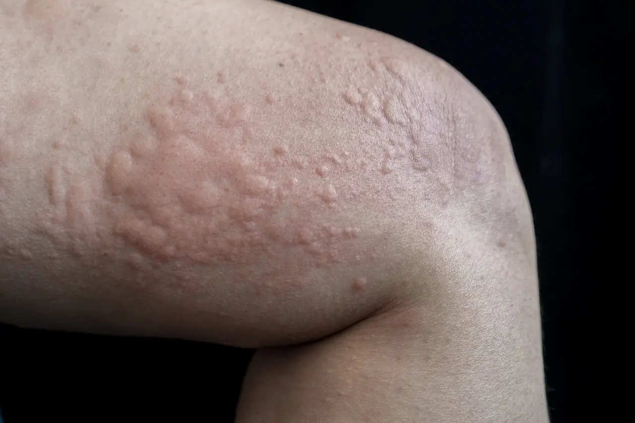 Urticaria (Hives) representation
